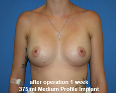 plastic-surgery-breast-augmentation